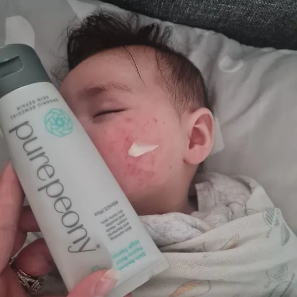 High Factor Peony Root Skin Remedy for eczema prone skin